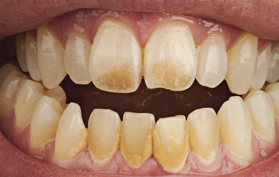 Можно ли курить айкос после отбеливания зубов – мнение стоматолога